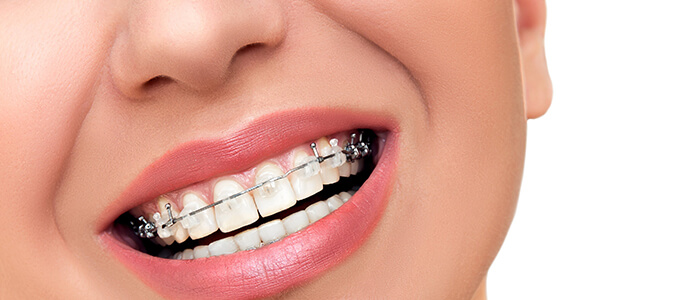 Braces and clear aligner treatment
